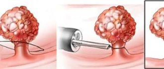 Removal of polyps in the intestines