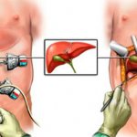 Gallbladder removal