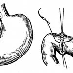 Suturing of duodenal ulcer