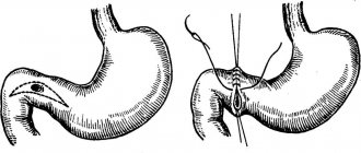 Suturing of duodenal ulcer