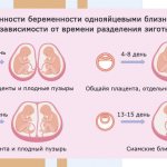 Варианты развития монозиготной двойни