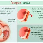 Types of gastritis