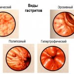 types of gastritis.jpg