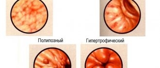 types of gastritis.jpg