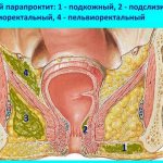 Types of paraproctitis