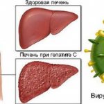 Viral hepatitis C