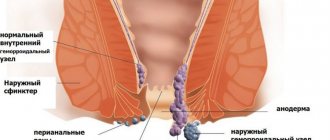 External and internal hemorrhoids