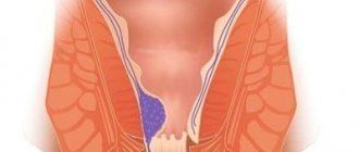 Internal and external hemorrhoids