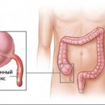 Inflammation of appendicitis