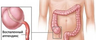 Inflammation of appendicitis