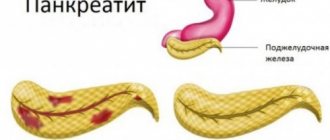 Inflammation of the pancreas