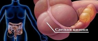 Inflammation of the cecum