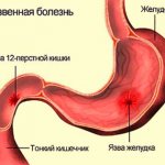 Peptic ulcer