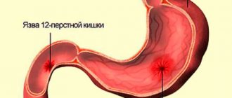 Peptic ulcer