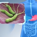 Заражение Helicobacter pylori