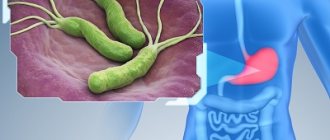 Заражение Helicobacter pylori