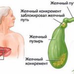 A gallstone has blocked the bile duct