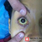 Jaundice phase of hepatitis